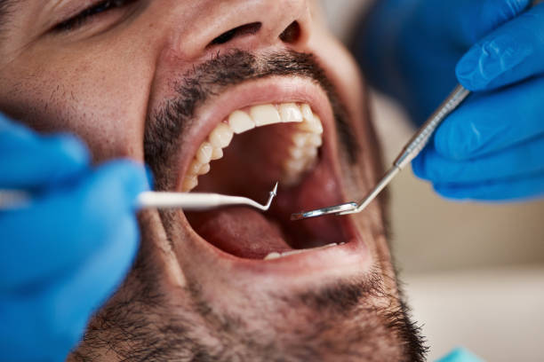 Best Wisdom Tooth Removal  in Battle Ground, WA
